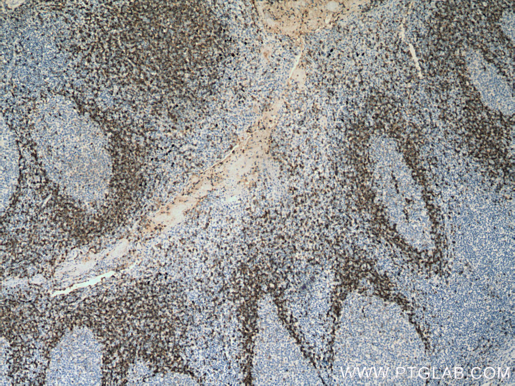 IHC staining of human tonsillitis using 67538-1-Ig (same clone as 67538-1-PBS)