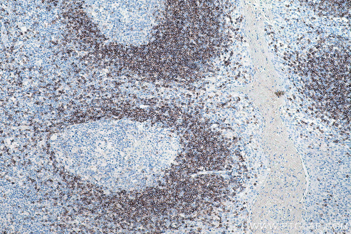 IHC staining of human tonsillitis using 67538-1-Ig (same clone as 67538-1-PBS)