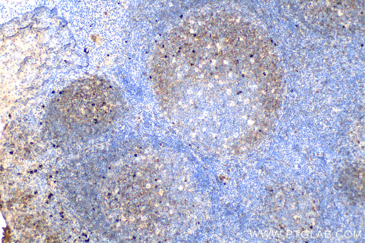 IHC staining of human tonsillitis using 66484-1-Ig (same clone as 66484-1-PBS)