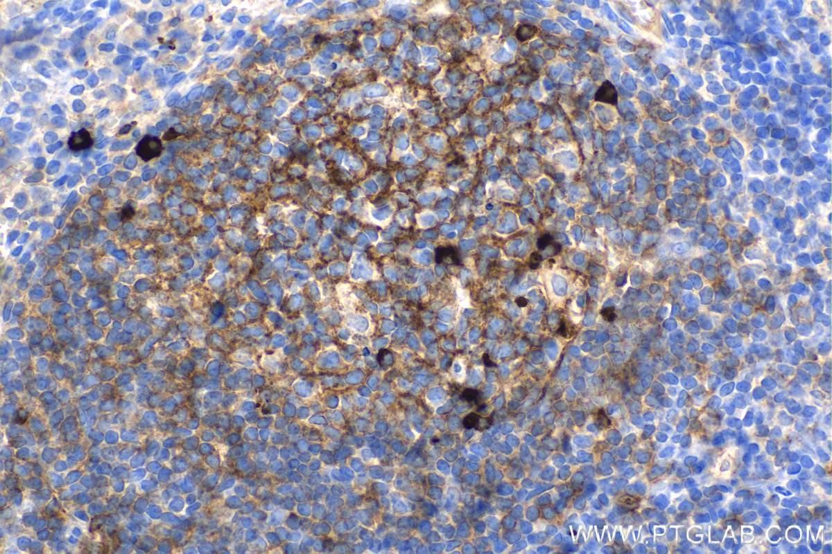 IHC staining of human tonsillitis using 66484-1-Ig (same clone as 66484-1-PBS)