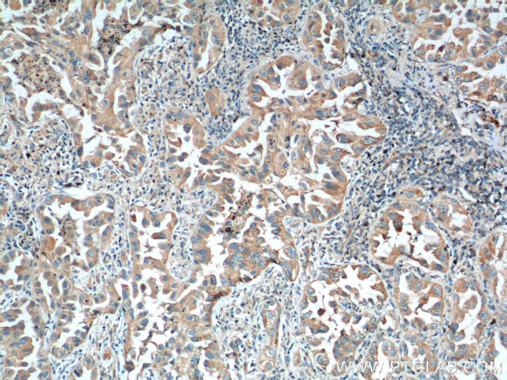 IHC staining of human lung cancer using 66333-1-Ig (same clone as 66333-1-PBS)
