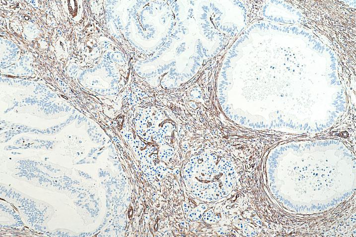 使用 Proteintech 的 Vimentin 小鼠单克隆抗体 (60330-1-Ig) 和兔/小鼠一抗自主全应用免疫组化试剂盒(PK10019) 对人胰腺组织进行免疫组织化学分析。