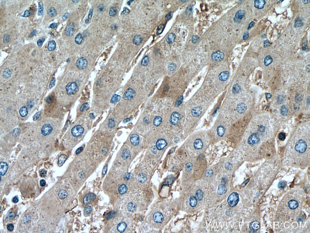 Immunohistochemical analysis of paraffin-embedded human liver cancer tissue slide using 67558-1-Ig (GSK3B-phospho-S9 antibody) at dilution of 1:300 (under 40x lens). Heat mediated antigen retrieval with Tris-EDTA buffer (pH 9.0).