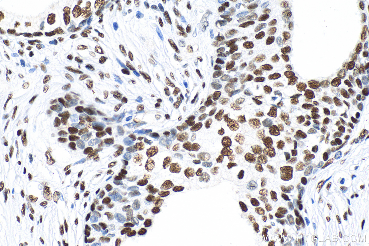 Immunohistochemical analysis of paraffin-embedded human prostate cancer tissue slide using 81871-1-RR (Phospho-CREB1 (Ser133) antibody) at dilution of 1:2000 (under 40x lens). Heat mediated antigen retrieval with Tris-EDTA buffer (pH 9.0).