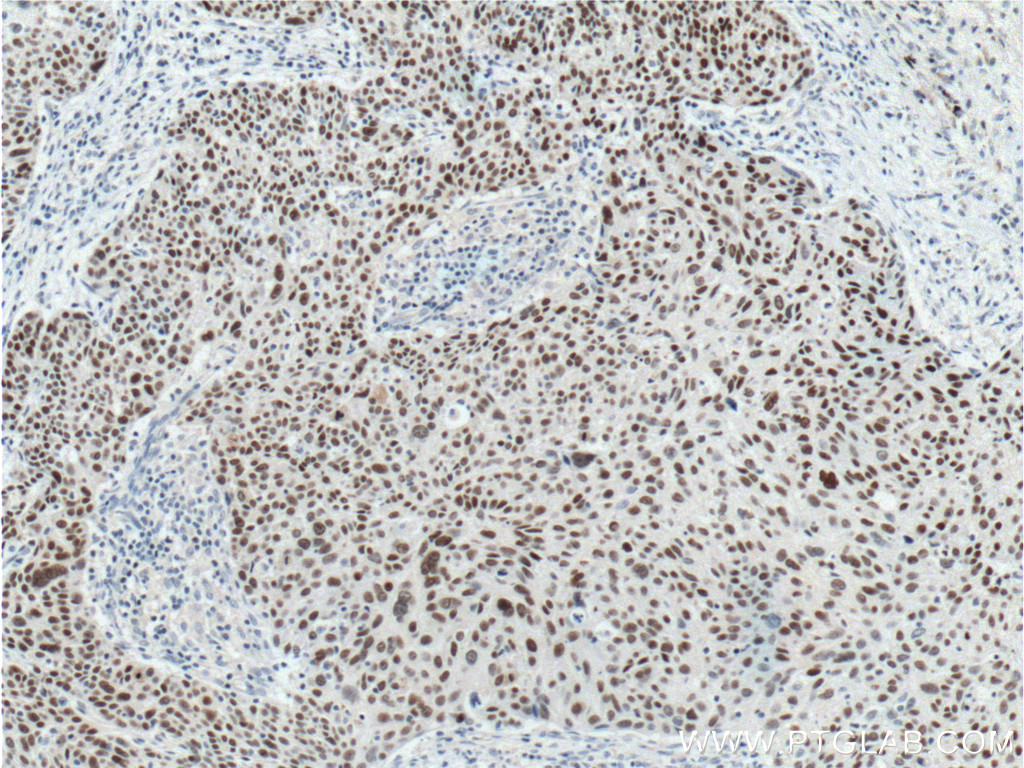 Immunohistochemical analysis of paraffin-embedded human lung cancer tissue slide using 66411-1-Ig (SOX2 Antibody) at dilution of 1:500 (under 10x lens). Heat mediated antigen retrieval with Tris-EDTA buffer (pH 9.0).