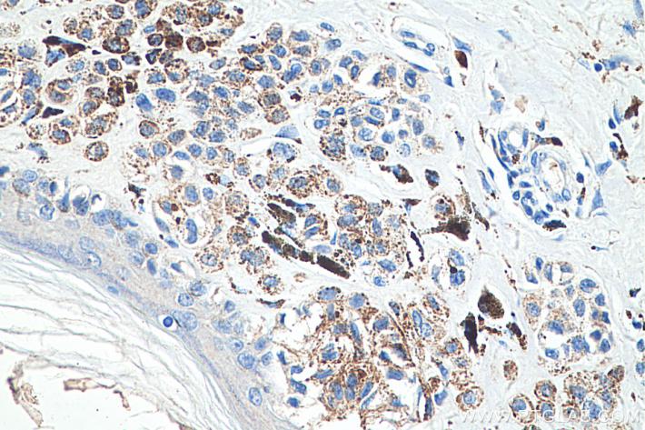 使用 Proteintech 的 ALPP 小鼠单克隆抗体 (60294-1-Ig) 对人类恶性黑色素瘤组织进行免疫组织化学分析。使用蛋白酶K抗原修复液 (PR30014) 在 37°C 孵育 15 分钟来进行蛋白酶诱导的表位修复。