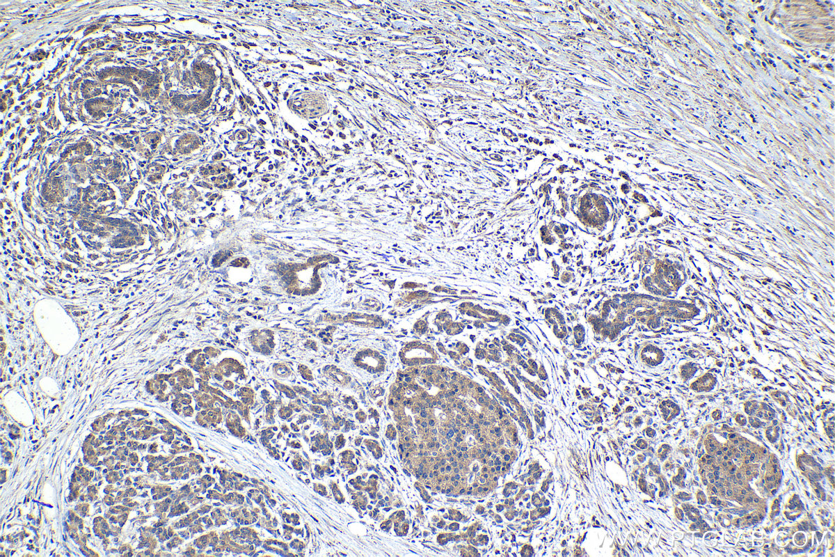 Immunohistochemical analysis of paraffin-embedded human pancreas cancer tissue slide using 21146-1-AP (LARS antibody) at dilution of 1:1000 (under 10x lens). Heat mediated antigen retrieval with Tris-EDTA buffer (pH 9.0). Multi-rAb Polymer HRP-Goat anti-rabbit Recombinant secondary antibody RGAR011 was used for detection.