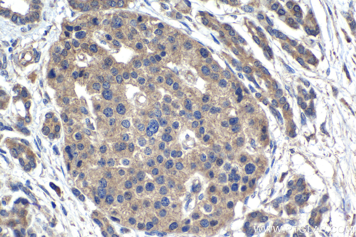 Immunohistochemical analysis of paraffin-embedded human pancreas cancer tissue slide using 21146-1-AP (LARS antibody) at dilution of 1:1000 (under 40x lens). Heat mediated antigen retrieval with Tris-EDTA buffer (pH 9.0). Multi-rAb Polymer HRP-Goat anti-rabbit Recombinant secondary antibody RGAR011 was used for detection.