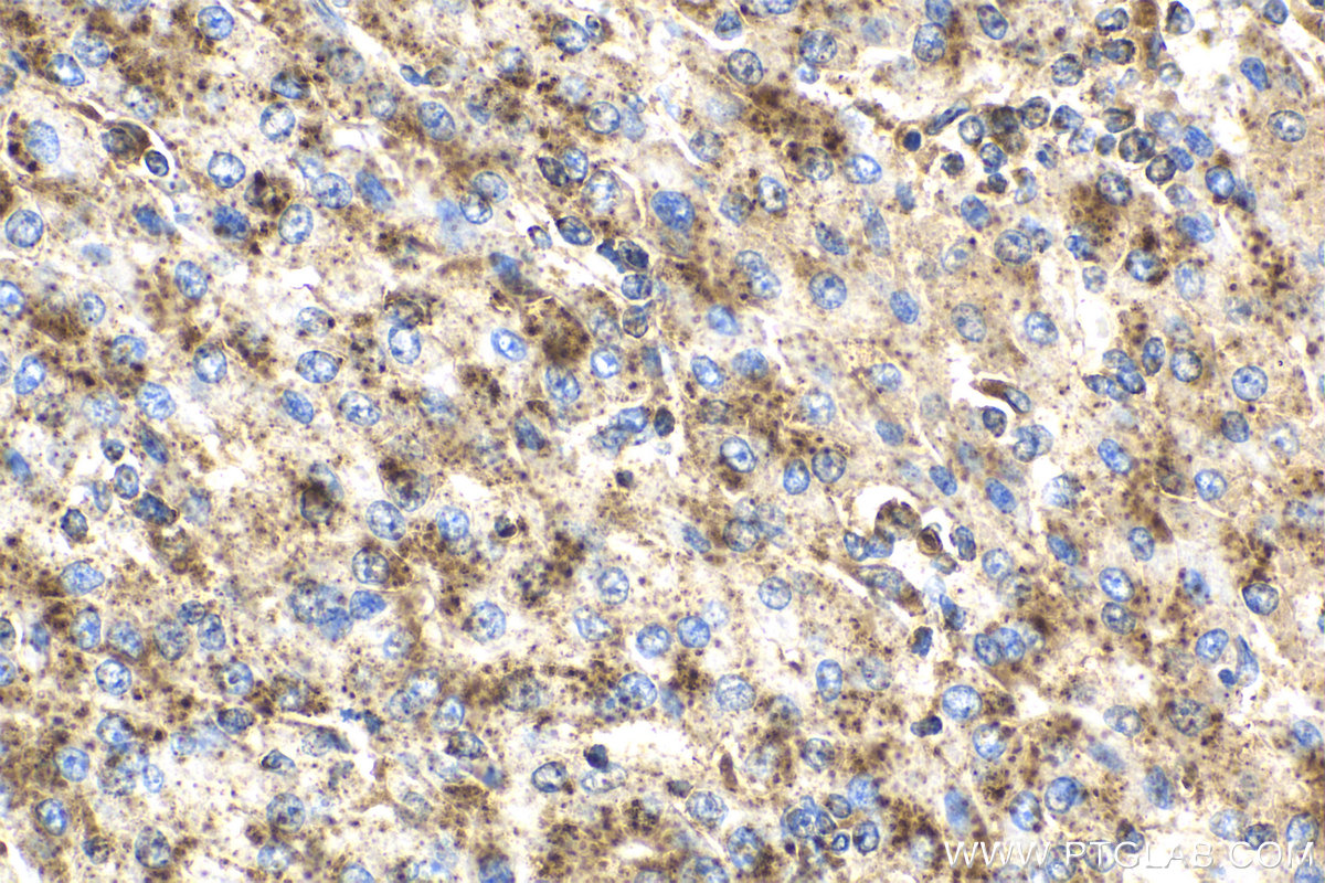 Immunohistochemical analysis of paraffin-embedded human liver cancer tissue slide using 67300-1-Ig (CD107a / LAMP1 antibody) at dilution of 1:4000 (under 40x lens). Heat mediated antigen retrieval with Tris-EDTA buffer (pH 9.0). Multi-rAb Polymer HRP-Goat Anti-Rabbit/Mouse Universal Recombinant secondary antibody RGAU011 was used for detection.