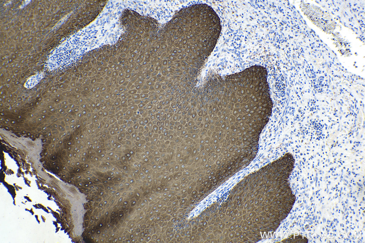 Immunohistochemical analysis of paraffin-embedded human skin cancer tissue slide using commercial IVD grade pan-CK mouse monoclonal antibody. Heat mediated antigen retrieval with Tris-EDTA buffer (pH 9.0). Multi-rAb Polymer HRP-Goat Anti-Rabbit/Mouse Universal Recombinant Secondary Antibody (H+L) RGAU011 was used for detection.