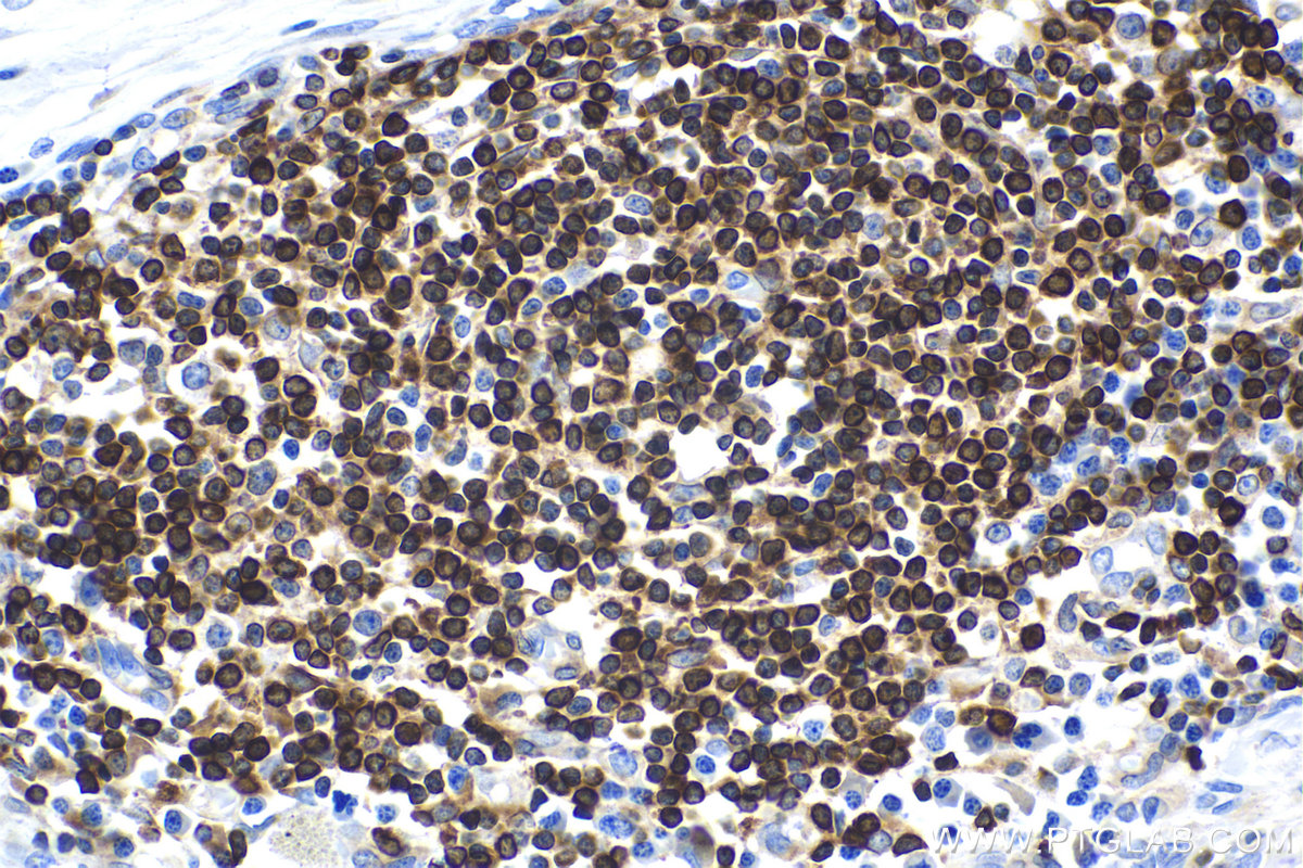Immunohistochemical analysis of paraffin-embedded human lymphoma tissue slide using other vendor's BCL2 rabbit recombinant antibody. Heat mediated antigen retrieval with Tris-EDTA buffer (pH 9.0). Multi-rAb Polymer HRP-Goat Anti-Rabbit/Mouse Universal Recombinant Secondary Antibody (H+L) RGAU011 was used for detection.