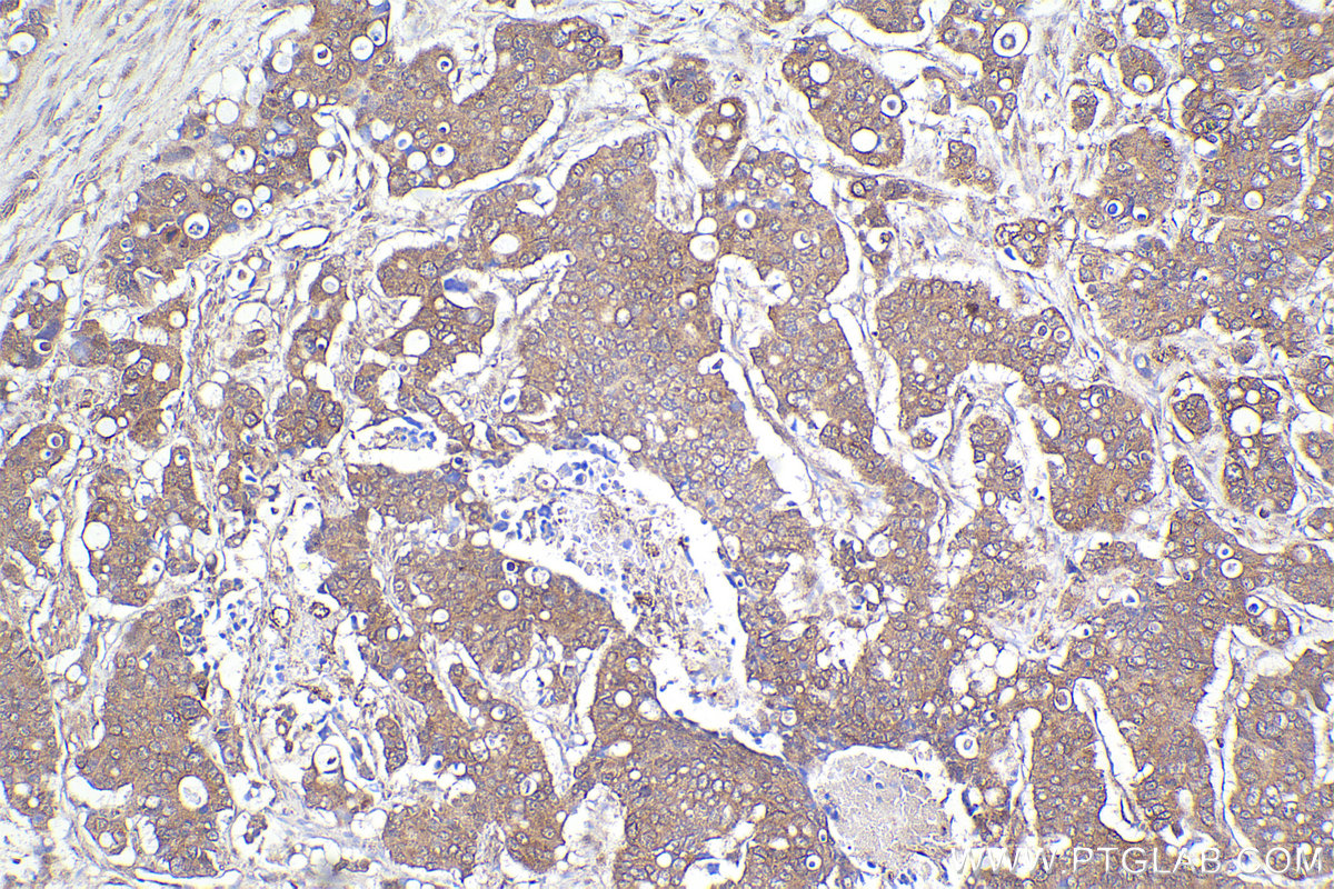 Immunohistochemical analysis of paraffin-embedded human stomach cancer tissue slide using KHC2216 (ABCD3 IHC Kit).