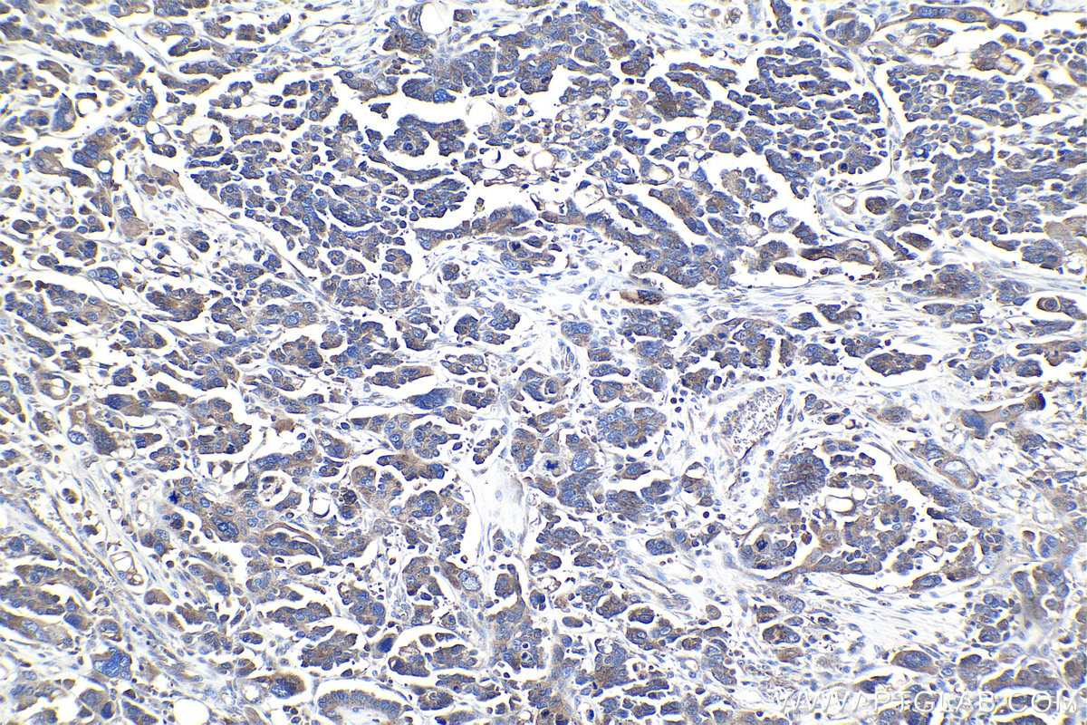 Immunohistochemical analysis of paraffin-embedded human colon cancer tissue slide using KHC0993 (AIP IHC Kit).
