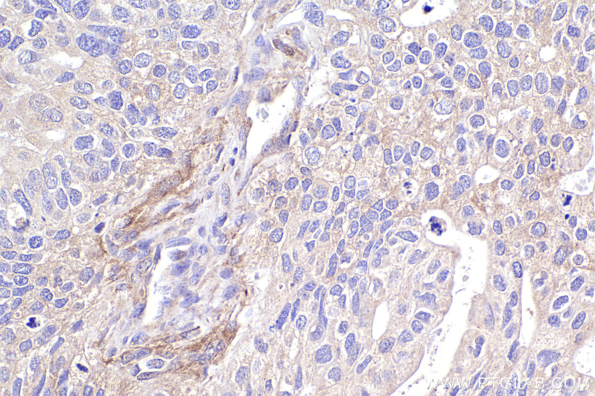 Immunohistochemical analysis of paraffin-embedded human ovary tumor tissue slide using KHC2382 (AMPD2 IHC Kit).