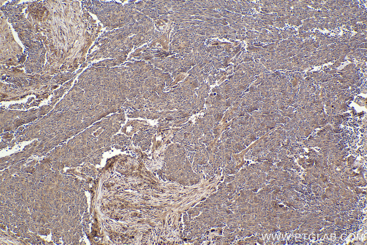 Immunohistochemical analysis of paraffin-embedded human lung cancer tissue slide using KHC2311 (ARHGDIA IHC Kit).