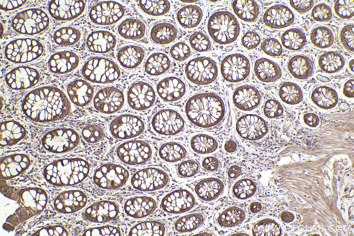 Immunohistochemical analysis of paraffin-embedded human rectal cancer tissue slide using KHC2449 (ARHGEF7 IHC Kit).