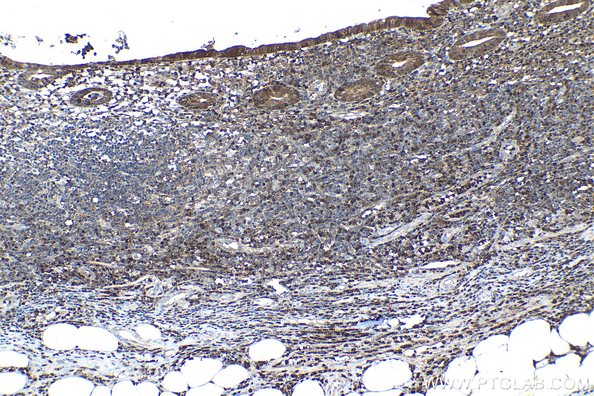 Immunohistochemical analysis of paraffin-embedded human appendicitis tissue slide using KHC1080 (ASC/TMS1 IHC Kit).