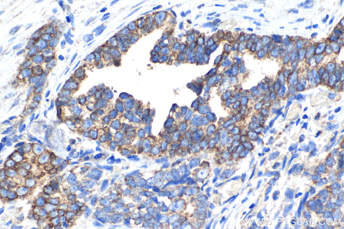 Immunohistochemical analysis of paraffin-embedded human ovary tumor tissue slide using KHC1234 (ASPH IHC Kit).