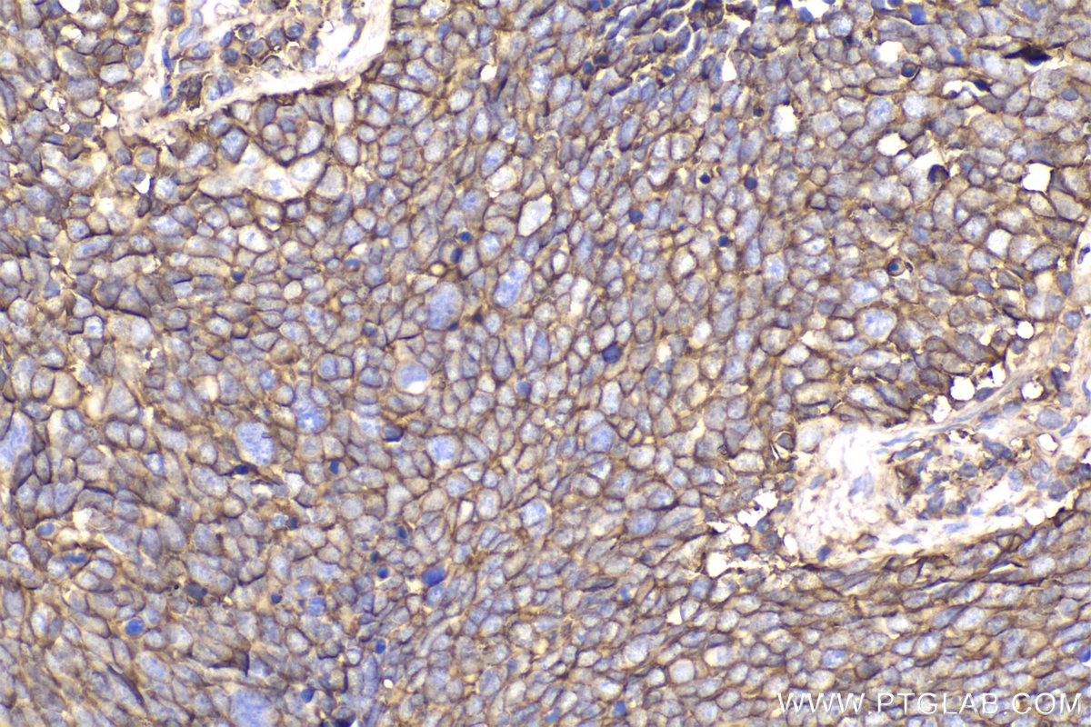 Immunohistochemical analysis of paraffin-embedded human lung cancer tissue slide using KHC2275 (ATP1A1 IHC Kit).