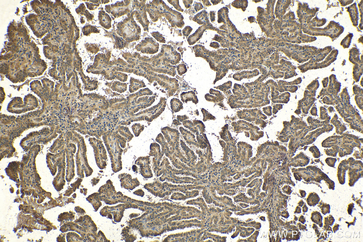 Immunohistochemical analysis of paraffin-embedded human thyroid cancer tissue slide using KHC2058 (BCKDK IHC Kit).