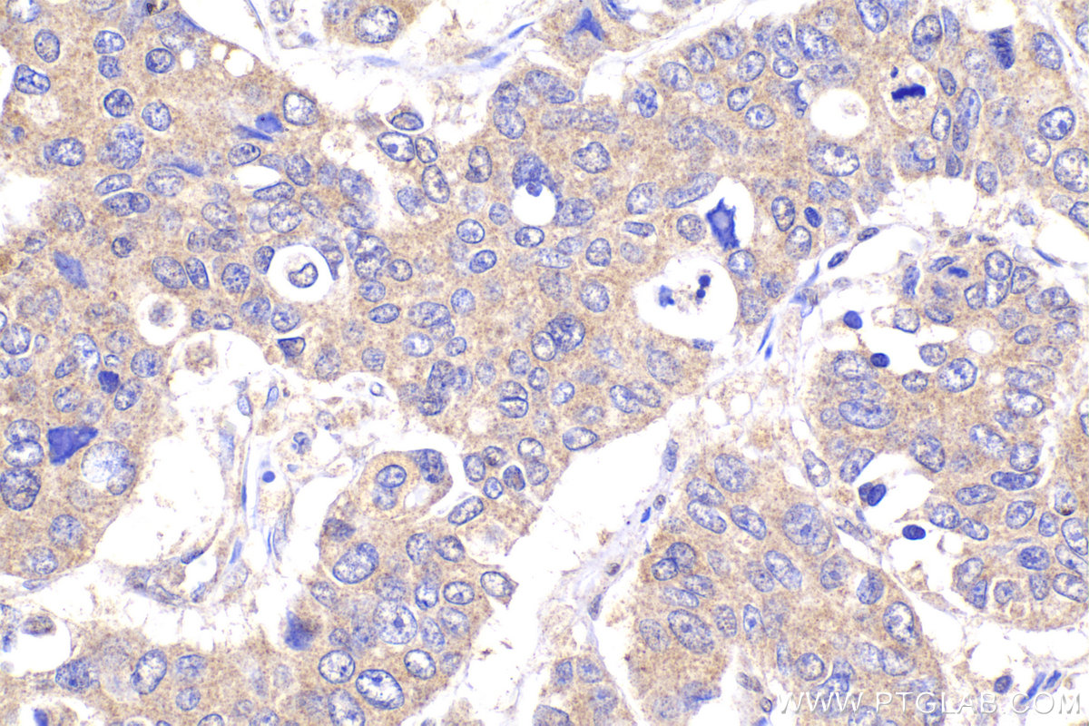 Immunohistochemical analysis of paraffin-embedded human stomach cancer tissue slide using KHC2183 (BMP4 IHC Kit).