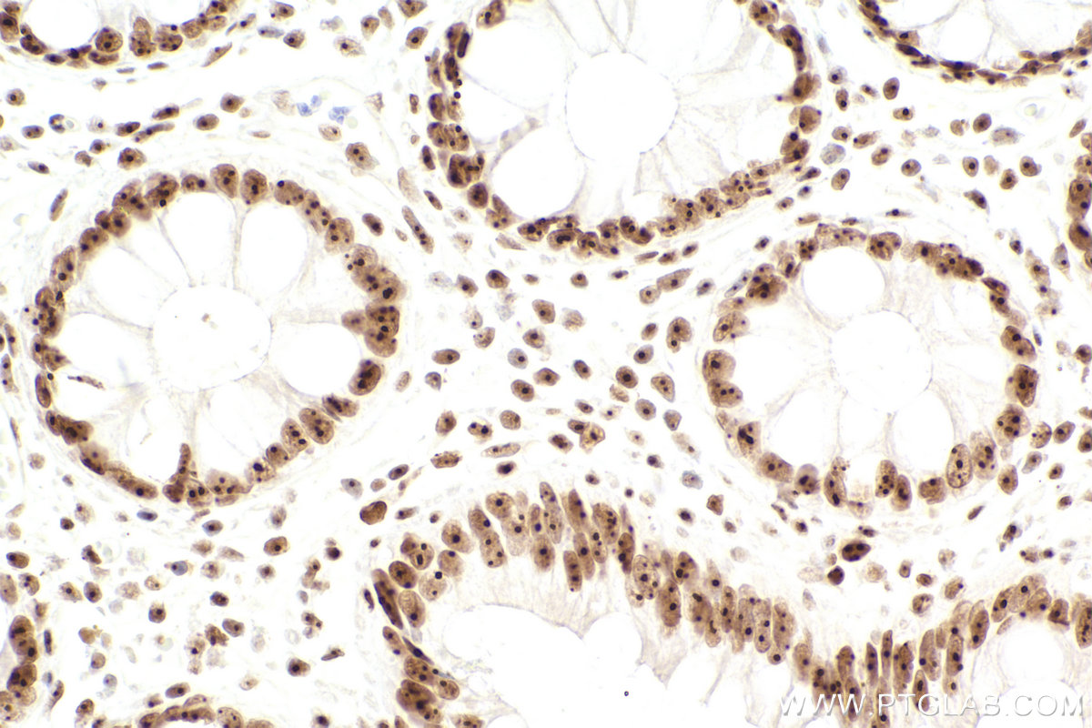 Immunohistochemical analysis of paraffin-embedded human rectal cancer tissue slide using KHC2447 (BOP1 IHC Kit).