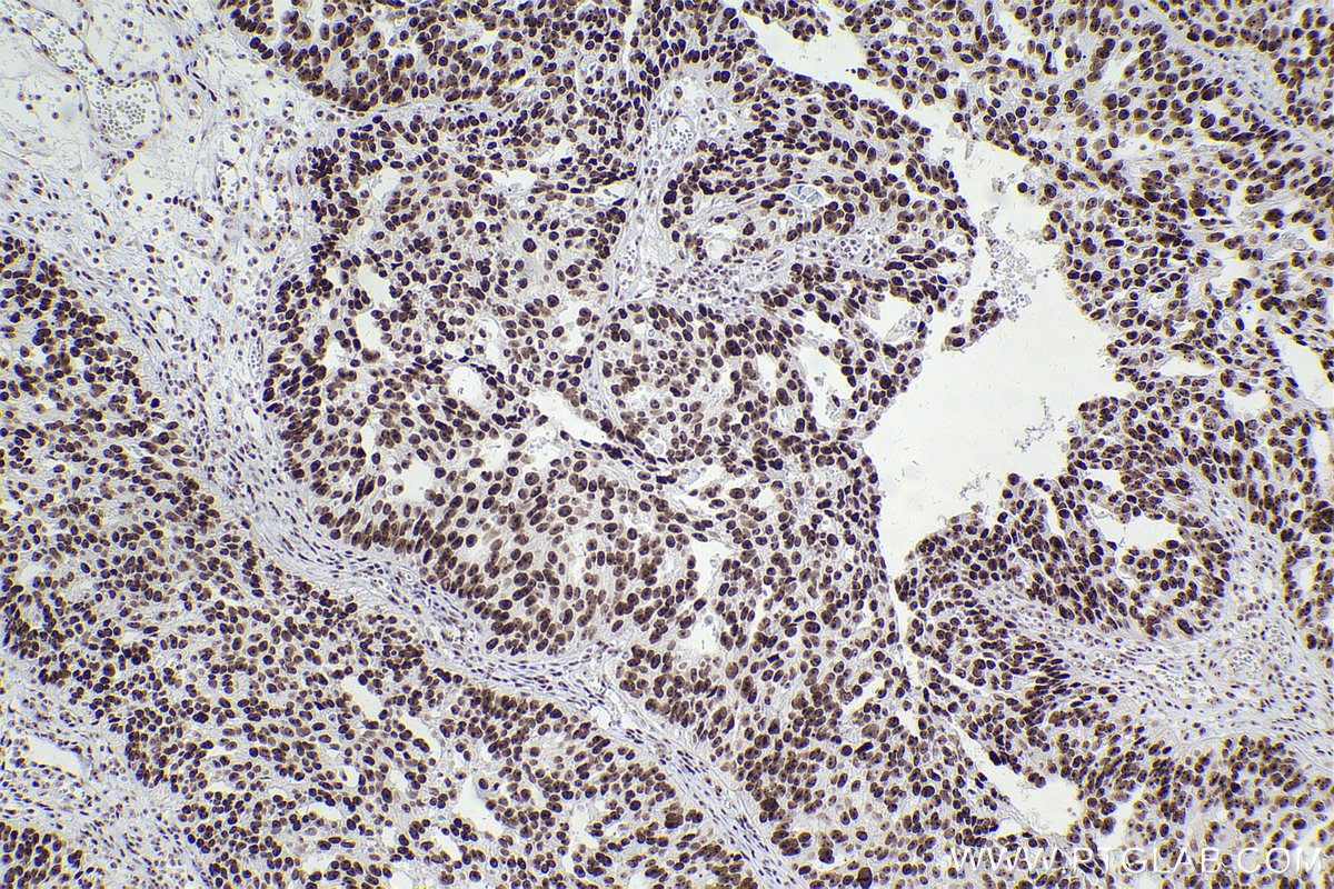 Immunohistochemical analysis of paraffin-embedded human ovary cancer tissue slide using KHC2447 (BOP1 IHC Kit).