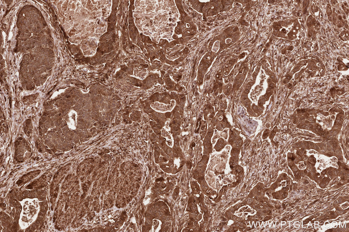 Immunohistochemical analysis of paraffin-embedded human stomach cancer tissue slide using KHC2590 (BORA IHC Kit).