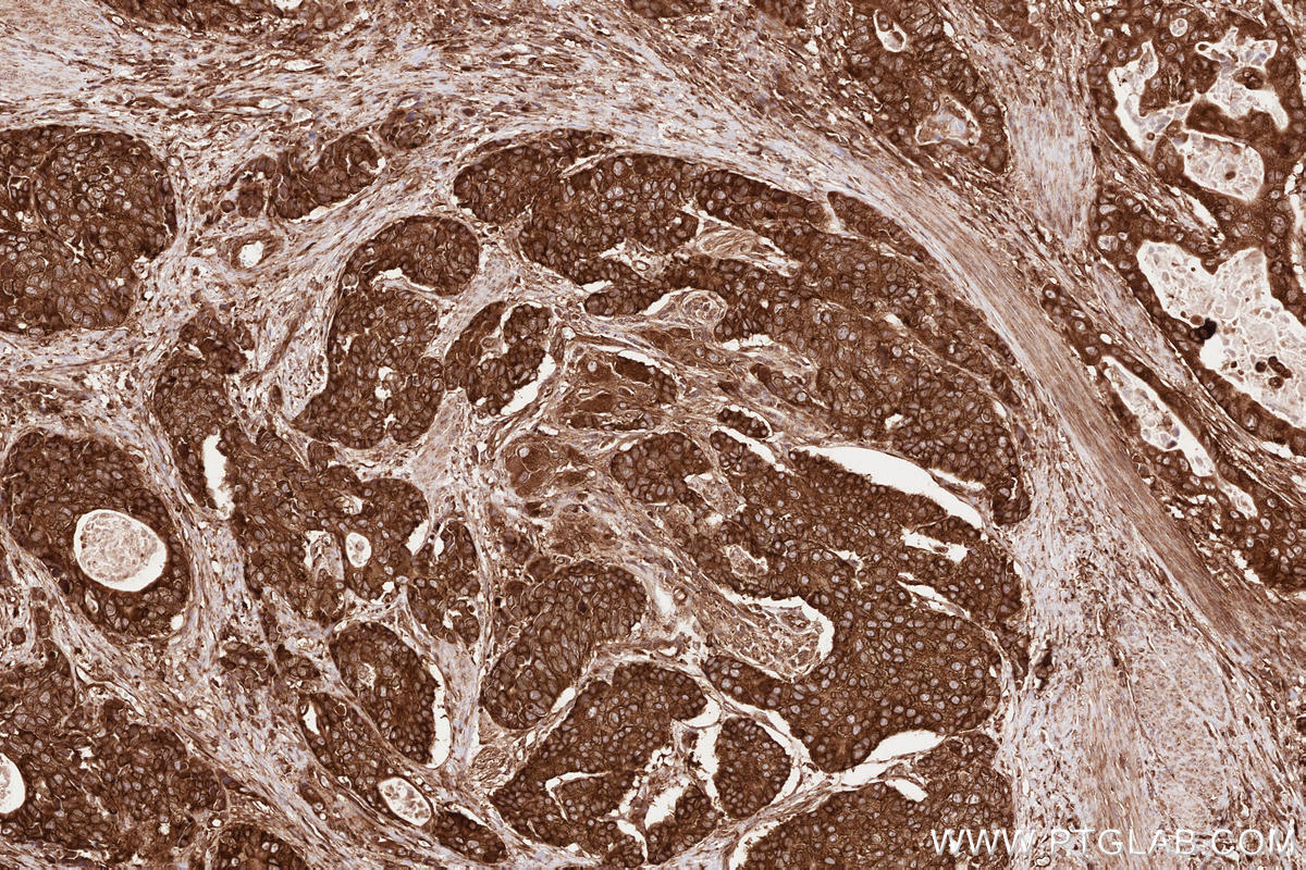 Immunohistochemical analysis of paraffin-embedded human stomach cancer tissue slide using KHC2528 (C9orf86 IHC Kit).