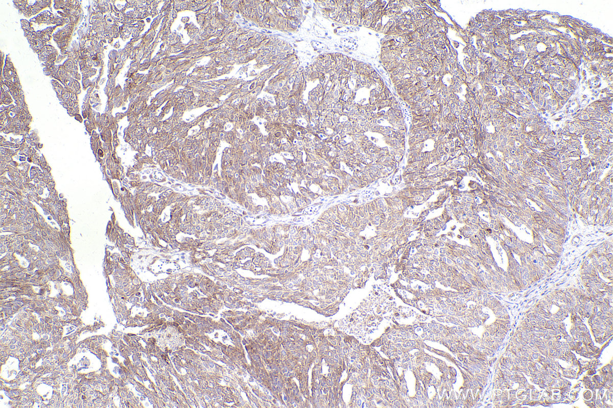 Immunohistochemical analysis of paraffin-embedded human ovary cancer tissue slide using KHC2433 (CAMK2D IHC Kit).