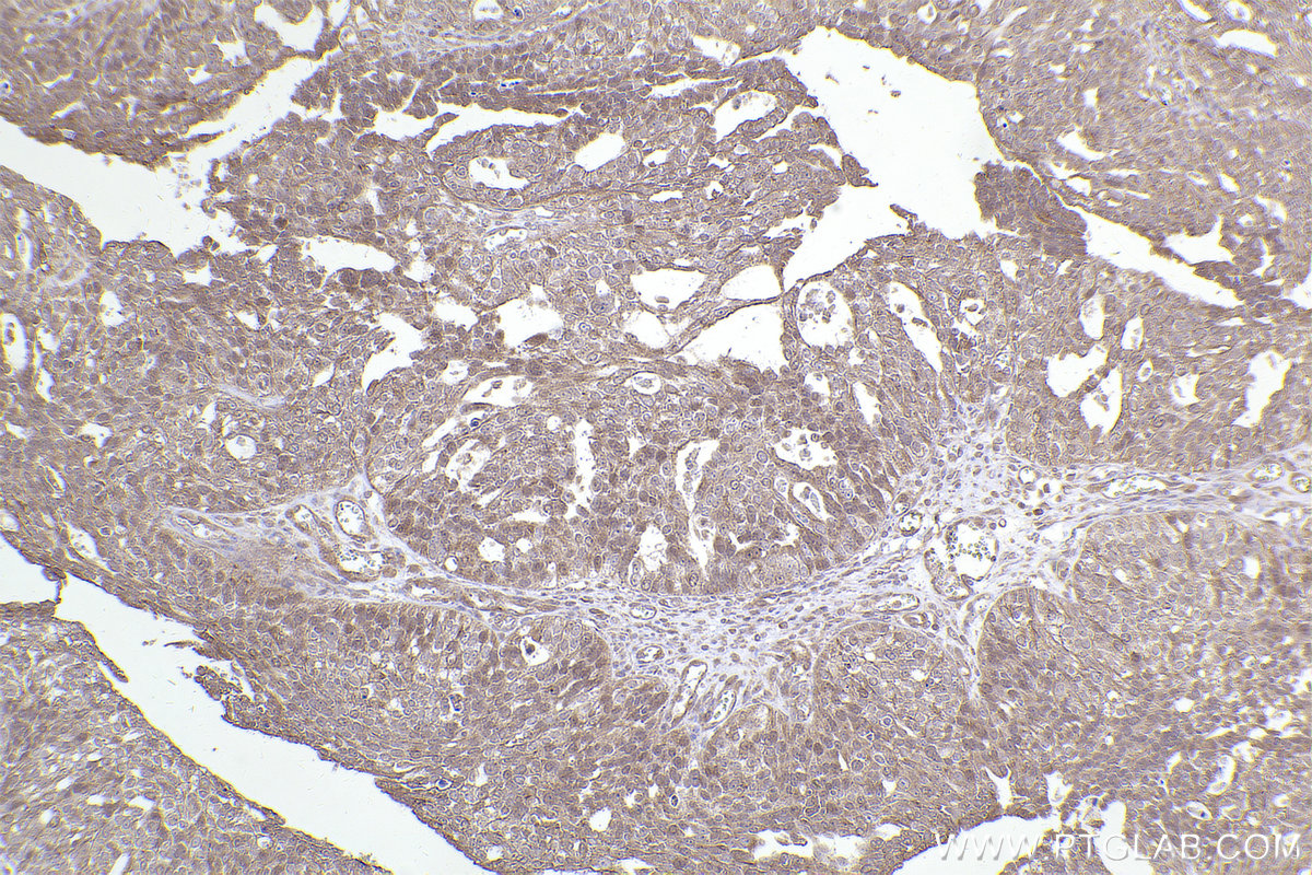 Immunohistochemical analysis of paraffin-embedded human ovary cancer tissue slide using KHC2432 (CAMK2G IHC Kit).