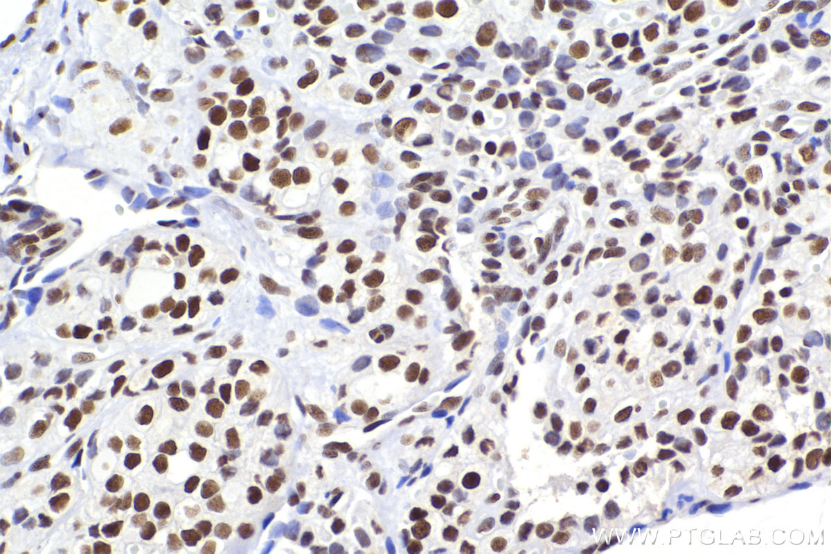 Immunohistochemical analysis of paraffin-embedded human thyroid cancer tissue slide using KHC2421 (CBX3 IHC Kit).