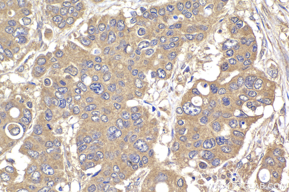 Immunohistochemical analysis of paraffin-embedded human stomach cancer tissue slide using KHC2185 (CCNB1 IHC Kit).