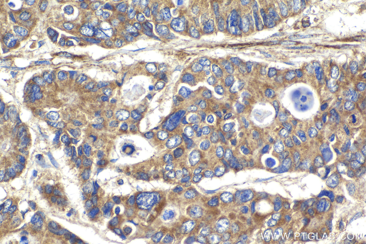 Immunohistochemical analysis of paraffin-embedded human stomach cancer tissue slide using KHC2138 (CCNDBP1 IHC Kit).