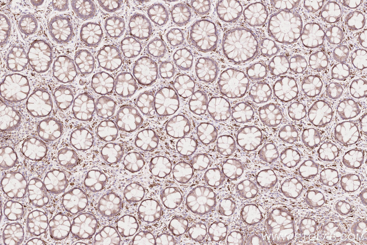 Immunohistochemical analysis of paraffin-embedded human rectal cancer tissue slide using KHC2581 (CCSAP IHC Kit).