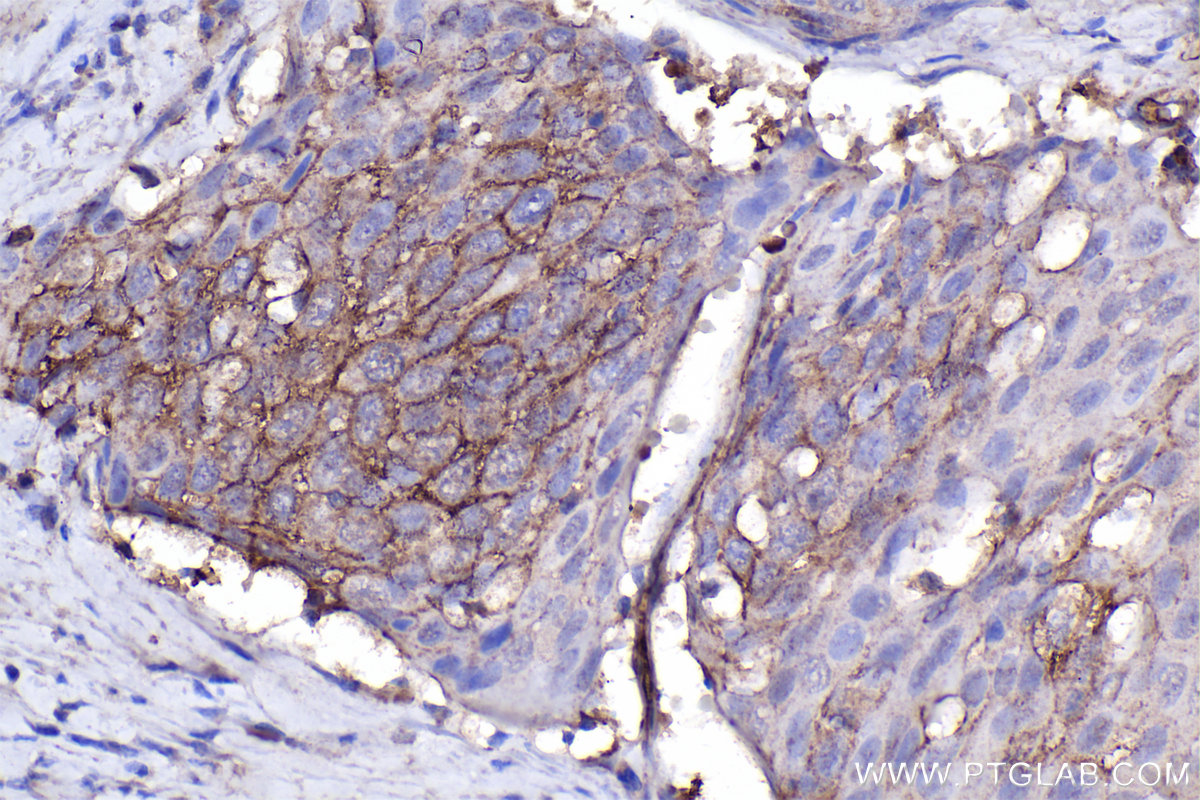 Immunohistochemical analysis of paraffin-embedded human cervical cancer tissue slide using KHC2274 (CD146/MCAM IHC Kit).