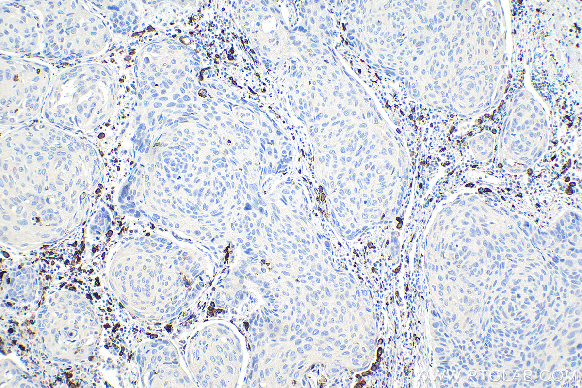 Immunohistochemical analysis of paraffin-embedded human lung cancer tissue slide using KHC0942 (CD163 IHC Kit).