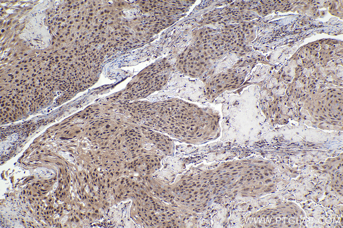 Immunohistochemical analysis of paraffin-embedded human cervical cancer tissue slide using KHC2228 (CDC25A IHC Kit).