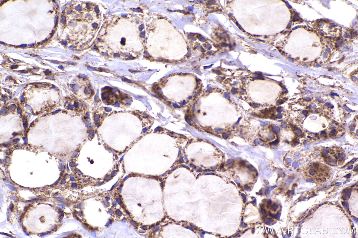 Immunohistochemical analysis of paraffin-embedded human thyroid cancer tissue slide using KHC2336 (CDC42 IHC Kit).