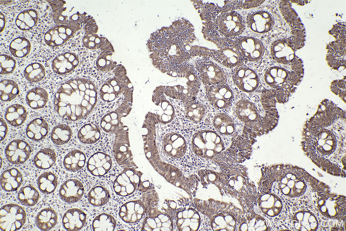 Immunohistochemical analysis of paraffin-embedded human rectal cancer tissue slide using KHC2480 (CDK10 IHC Kit).