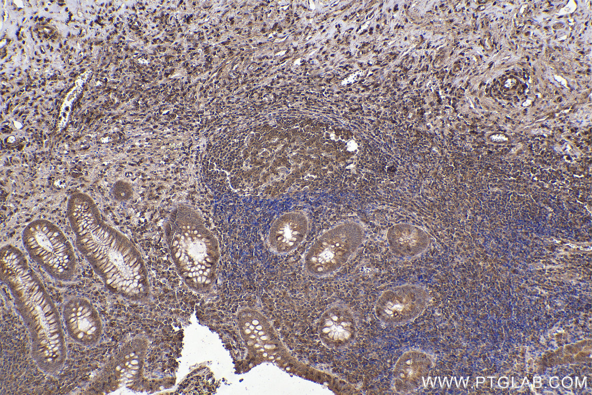 Immunohistochemical analysis of paraffin-embedded human appendicitis tissue slide using KHC2212 (CDK2 IHC Kit).