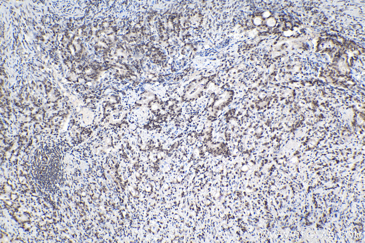 Immunohistochemical analysis of paraffin-embedded human stomach cancer tissue slide using KHC2124 (CDK2AP2 IHC Kit).