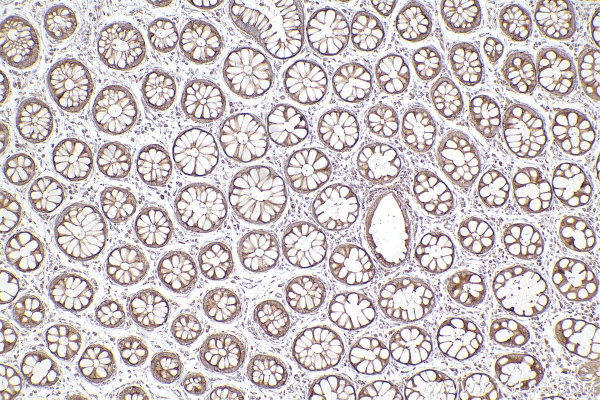 Immunohistochemical analysis of paraffin-embedded human rectal cancer tissue slide using KHC2444 (CKAP5/Ch-TOG IHC Kit).