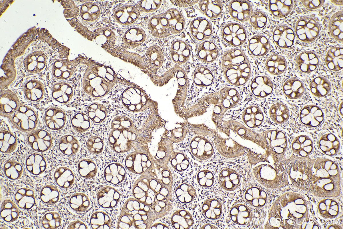 Immunohistochemical analysis of paraffin-embedded human rectal cancer tissue slide using KHC2463 (CLINT1 IHC Kit).