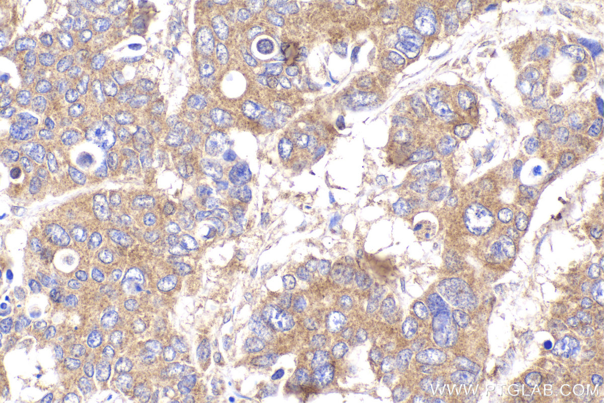 Immunohistochemical analysis of paraffin-embedded human stomach cancer tissue slide using KHC2230 (CLIP1 IHC Kit).