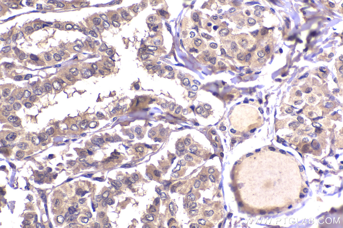 Immunohistochemical analysis of paraffin-embedded human thyroid cancer tissue slide using KHC2319 (CLTCL1 IHC Kit).