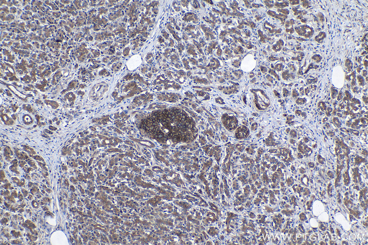 Immunohistochemical analysis of paraffin-embedded human pancreas cancer tissue slide using KHC1292 (COG3 IHC Kit).