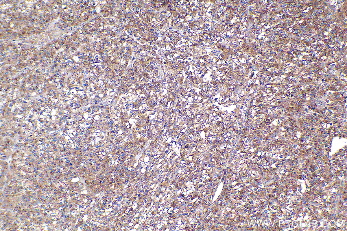 Immunohistochemical analysis of paraffin-embedded human endometrial cancer tissue slide using KHC2371 (COG7 IHC Kit).