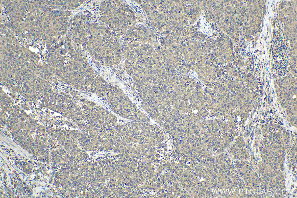 Immunohistochemical analysis of paraffin-embedded human stomach cancer tissue slide using KHC1639 (COPS2 IHC Kit).