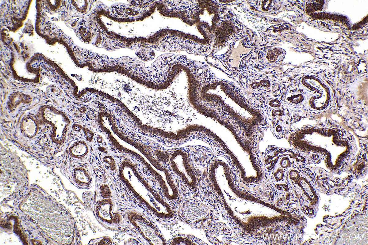 Immunohistochemical analysis of paraffin-embedded human ovary tumor tissue slide using KHC2437 (CUL2 IHC Kit).